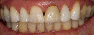 Patient's smile before dental treatment